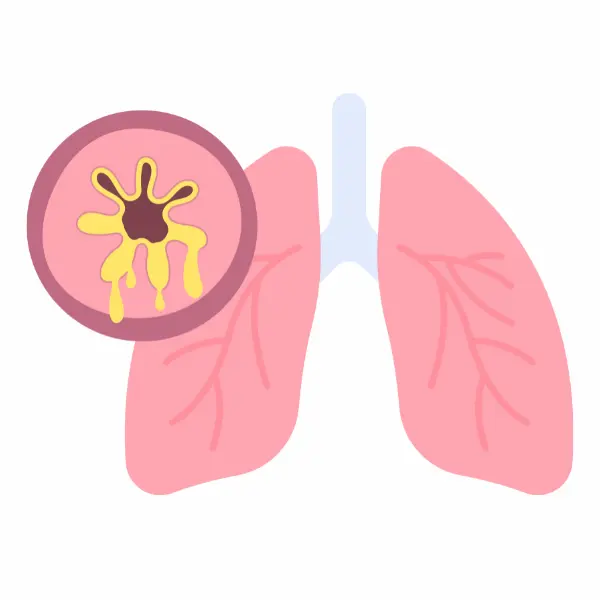 infecciones respiratorias - bronquiolitis